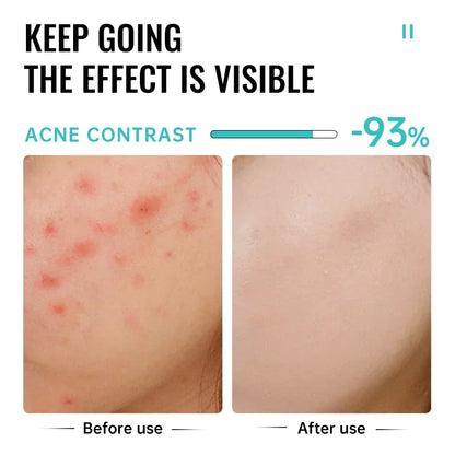 Salicylic Acid Acne Treatment Cream Repair Pimple Spots Serum Cleaning Pore Anti-acne Oil Control Moisturizer Smooth Skin Care