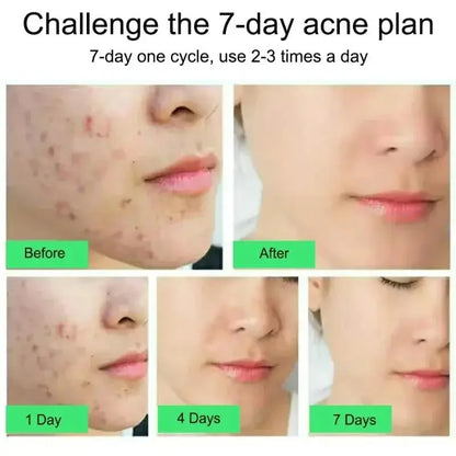 Salicylic Acid Acne Treatment Cream Repair Pimple Spots Serum Cleaning Pore Anti-acne Oil Control Moisturizer Smooth Skin Care