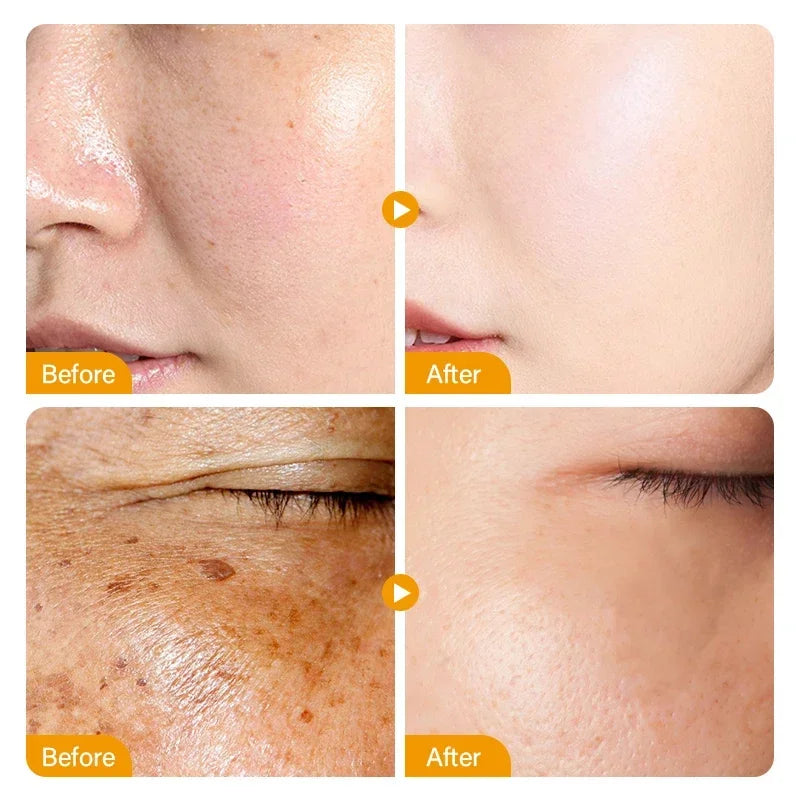 Vitamin C Whitening Freckles Serum Cream Remove Dark Spots Melasma Niacinamide Lighten Melanin Acne Scars Anti-aging Skin Care