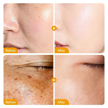 Vitamin C Whitening Freckles Serum Cream Remove Dark Spots Melasma Niacinamide Lighten Melanin Acne Scars Anti-aging Skin Care