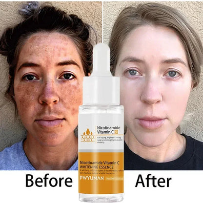 Vitamin C Whitening Freckles Serum Cream Remove Dark Spots Melasma Niacinamide Lighten Melanin Acne Scars Anti-aging Skin Care